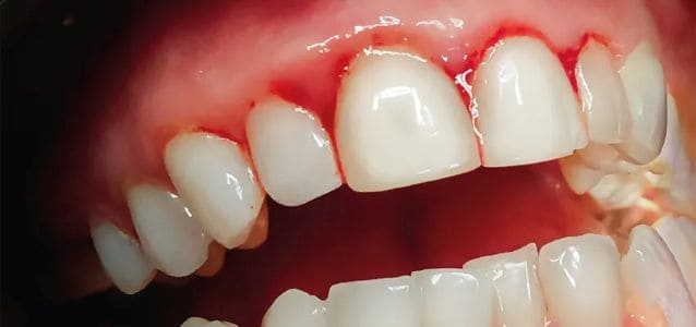 Imagem de uma gengiva sangrando por falta de nutrientes