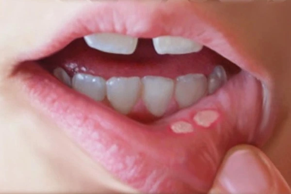Imagem mostra boca com afta por falta de vitamina do complexo B