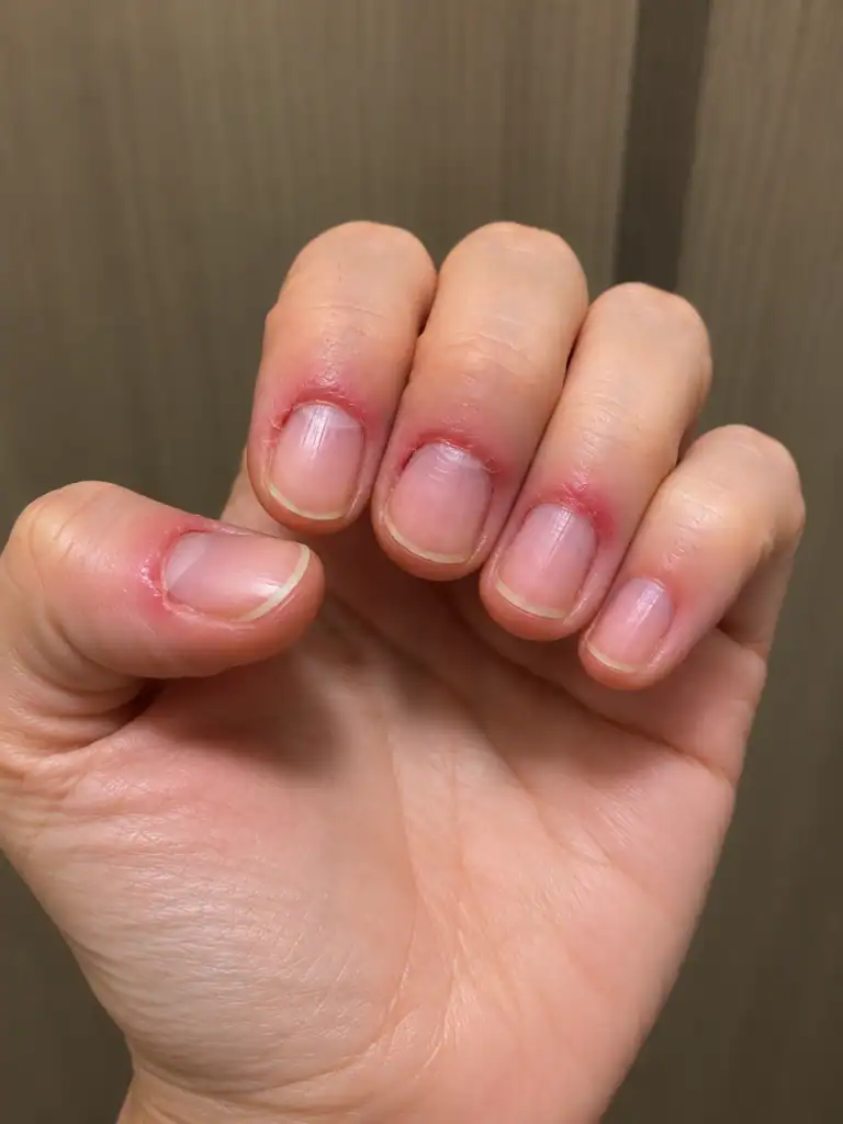 Roer as unhas, mexer na cutícula e esconder uma unha verde: 3 hábitos que podem aumentar o risco de infecção.